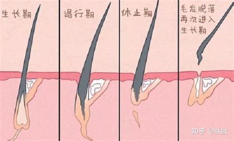 毛发倒生|毛发内生的病因